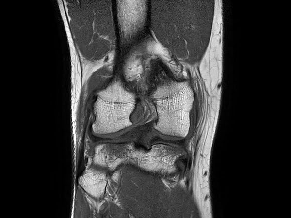 Philips Ingenia Ambition 1.5 T X: Compressed SENSE ускоряет 2D и 3D-сканирование до 50%, при этом качество изображений практически не страдает